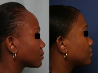 Hairline lowering before 147598
