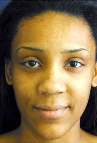 Ethnic Rhinoplasty before 312665