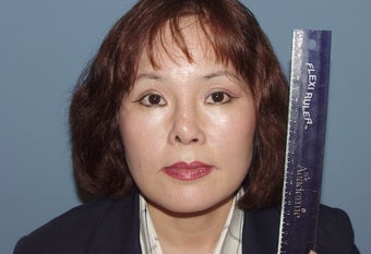 Correction of badly performed Asian rhinoplasty before 892534