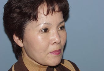 Correction of badly performed Asian rhinoplasty 892534