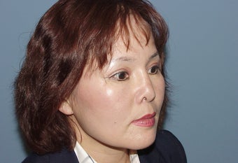 Correction of badly performed Asian rhinoplasty 892534
