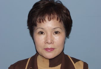 Correction of badly performed Asian rhinoplasty after 892534