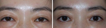 Before and after Asian Blepharoplasty with Arcus Release and Fat Grafting before 1094139