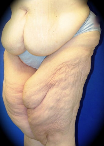 Thigh Lift before 837131