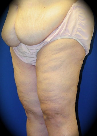 Thigh Lift after 837131