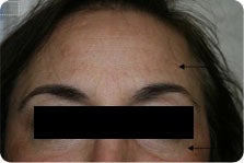 Pixel Laser after 207827