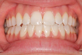 27 Year Old Female Clear Braces after 1305072