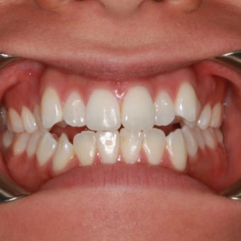 27 Year Old Female Clear Braces before 1305072