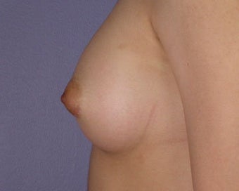 Breast Augmentation after 281396