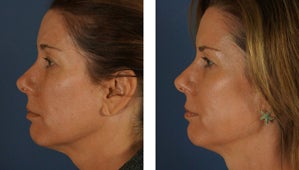 Botox and Fillers Around the Eyes - Female after 1290365