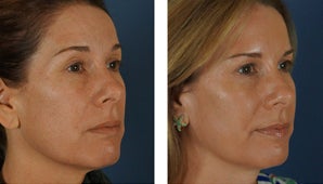 Botox and Fillers Around the Eyes - Female before 1290365