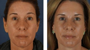 Botox and Fillers Around the Eyes - Female 1290365