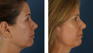 Botox and Fillers Around the Eyes - Female 1290365