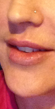 Filler for Lips after 1275824
