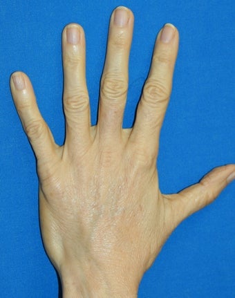 Hand Rejuvenation with Filler after 817011