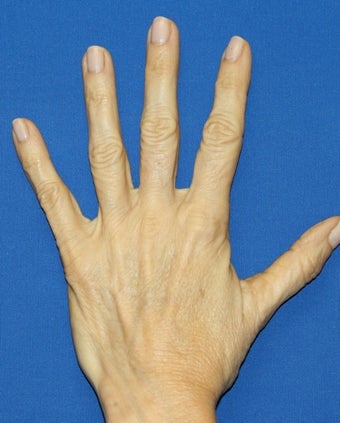 Hand Rejuvenation with Filler before 817011