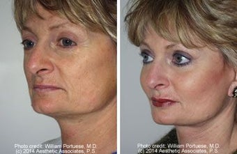 Cheek and Chin Implants, Neck Lift before 6778