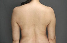 SmartLipo MPX of back and flanks after 110499