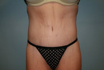 Total Body Lift after 304447