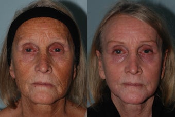 Treatment of aging and sun damage with laser resurfacing, before filler before 1314970