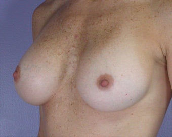 Breast Implant Correction after 281300