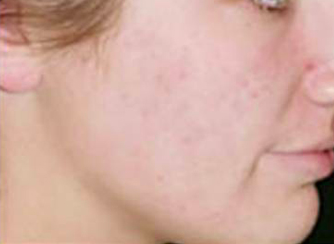 Mesotherapy after 920810