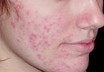 Mesotherapy before 920810