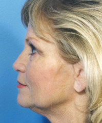 Facelift 507825