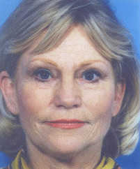 Facelift before 507825