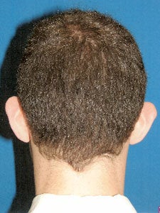 Otoplasty Ear Surgery - Boy 818051
