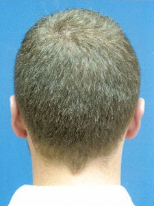 Otoplasty Ear Surgery - Boy 818051