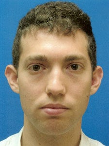 Otoplasty Ear Surgery - Boy before 818051