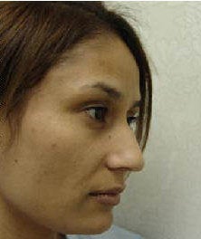 Rhinoplasty before 172973