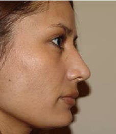 Rhinoplasty after 172973