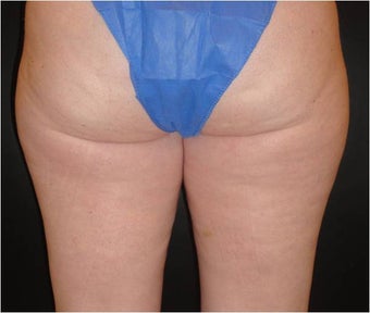 SmartLipo MPX before 686123