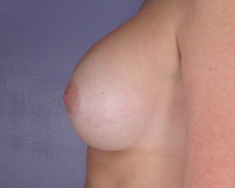 Breast Augmentation after 281411