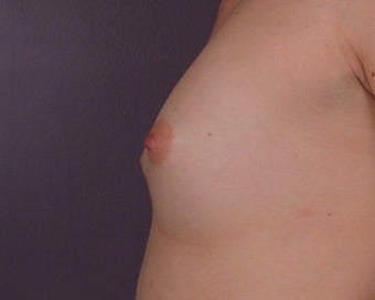 Breast Augmentation before 281411