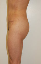 buttock Augmentation after 333751