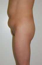 buttock Augmentation before 333751