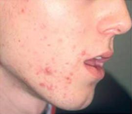 Mesotherapy before 920817