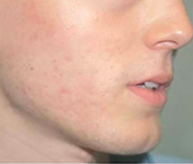 Mesotherapy after 920817