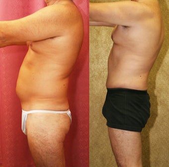 Male abdominoplasty or tummy tuck before 232464