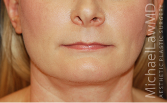 Chin Liposuction - Lower Facial Rejuvenation 674078