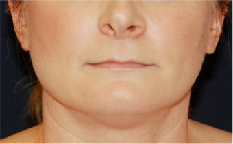 Chin Liposuction - Lower Facial Rejuvenation 674078