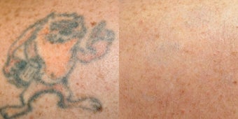 PicoSure before 1006788