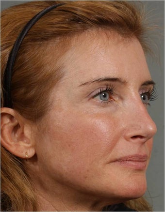 45 year old female with a nasal deformity after rhinoplasty with obstruction requesting revision surgery 1017721