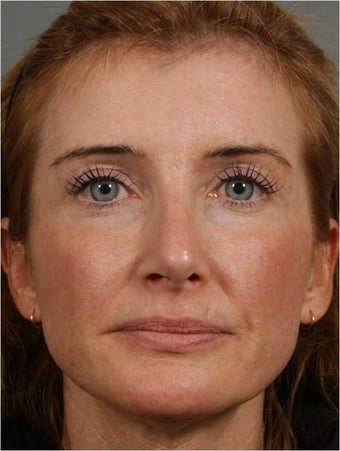 45 year old female with a nasal deformity after rhinoplasty with obstruction requesting revision surgery after 1017721