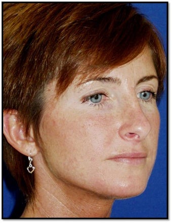 45 year old female with a nasal deformity after rhinoplasty with obstruction requesting revision surgery 1017721