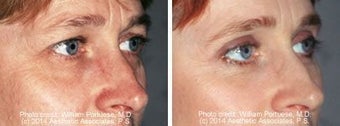 Blepharoplasty before 91480