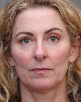 Cheek Augmentation Using Juvederm before 658794